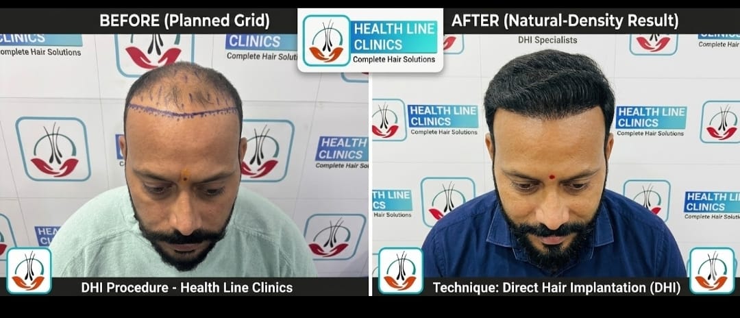 कानपुर हेयर ट्रांसप्लांट रिज़ल्ट - DHI before and after