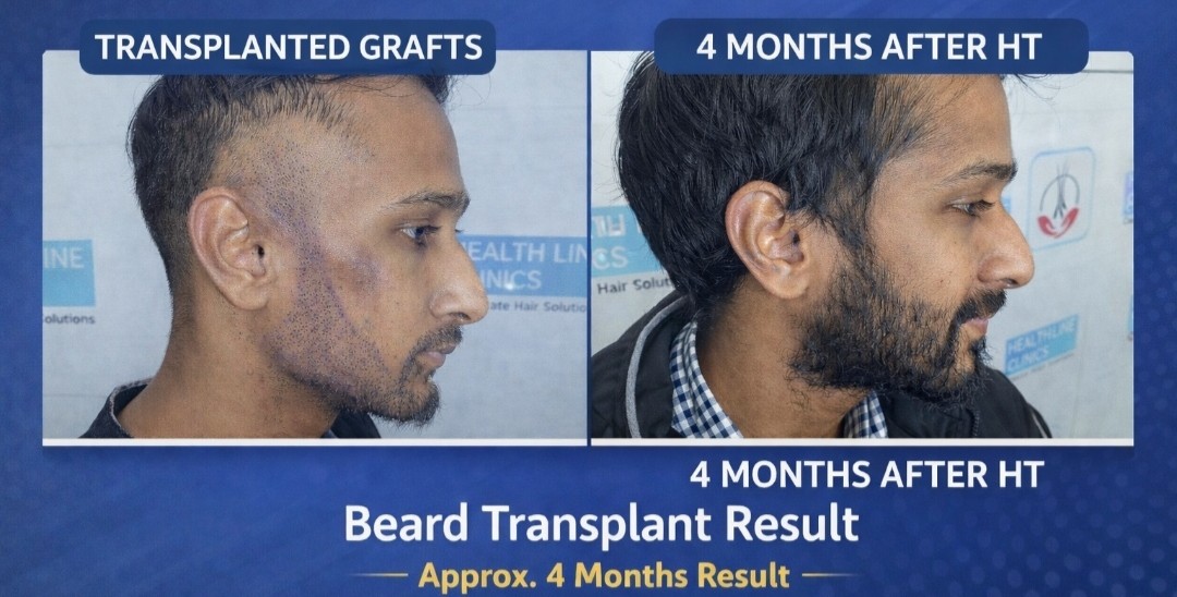 FUE before after कानपुर - बियर्ड ट्रांसप्लांट रिज़ल्ट 4 महीने