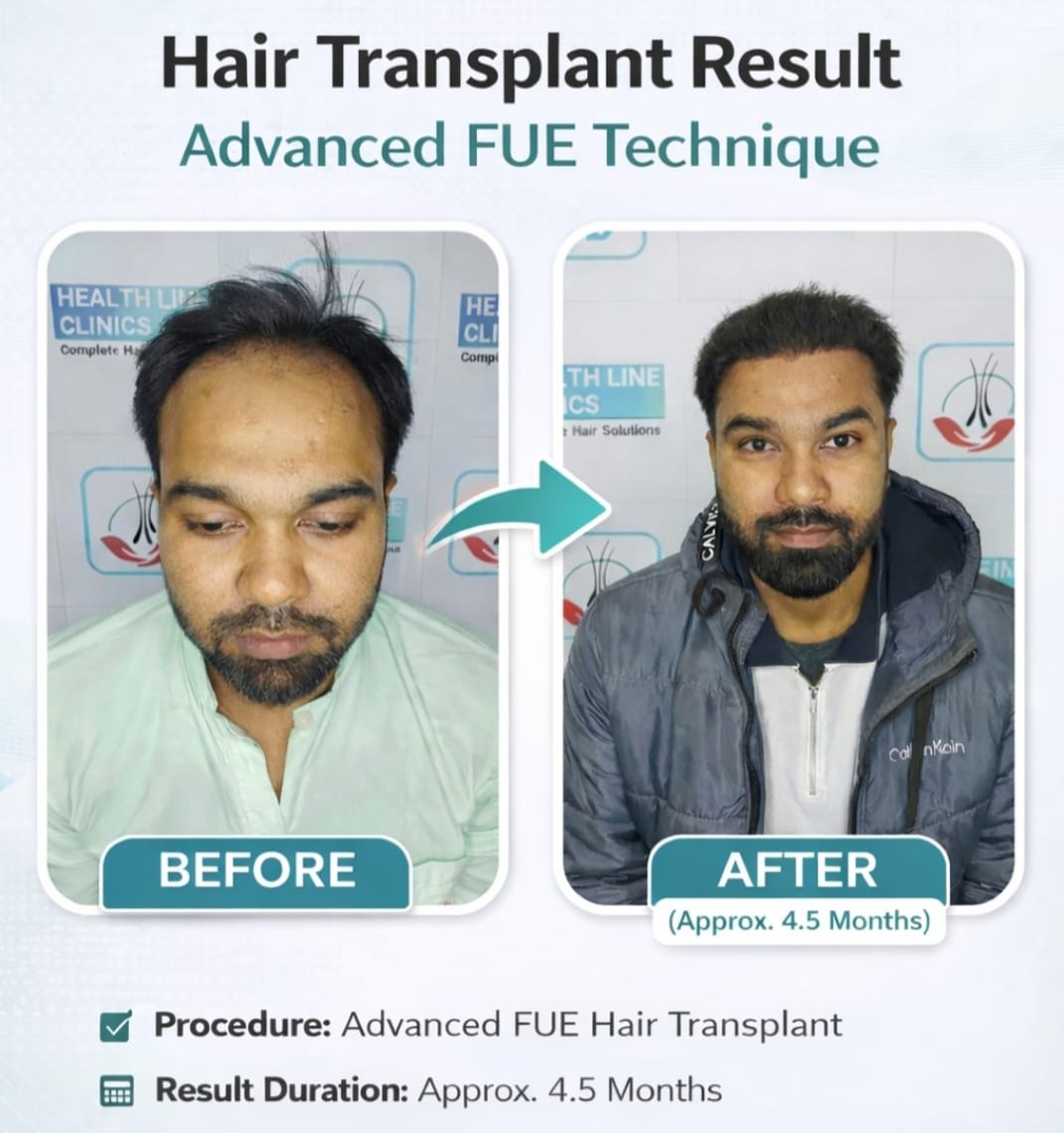 कानपुर हेयर ट्रांसप्लांट रिज़ल्ट - FUE before after