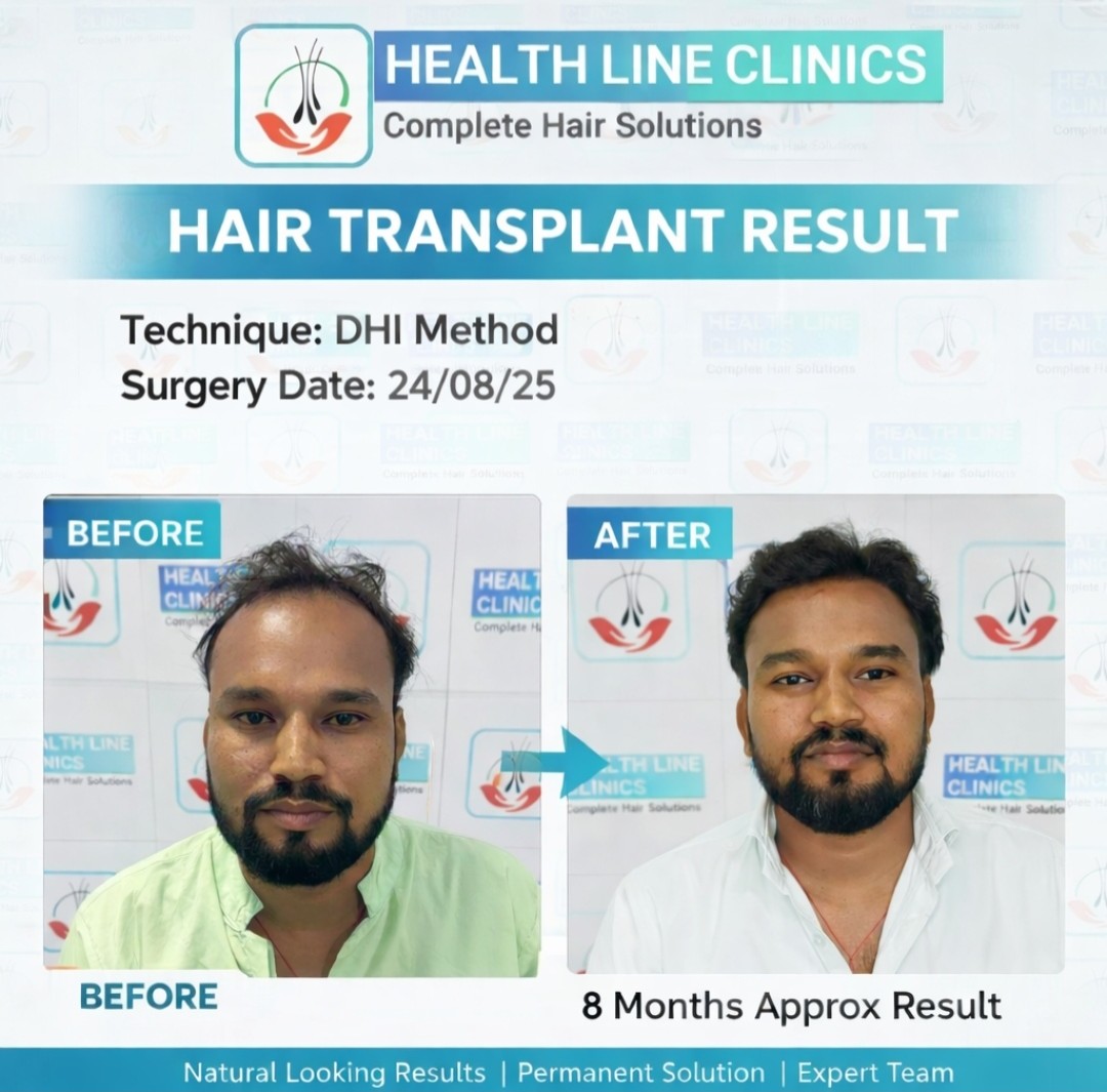 FUE before after कानपुर - 4.5 महीने का हेयर ट्रांसप्लांट रिज़ल्ट